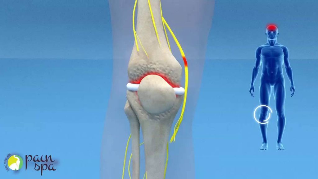 Genicular Nerve Block