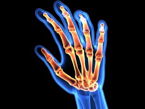 Rheumatoid arthritis Indonesia