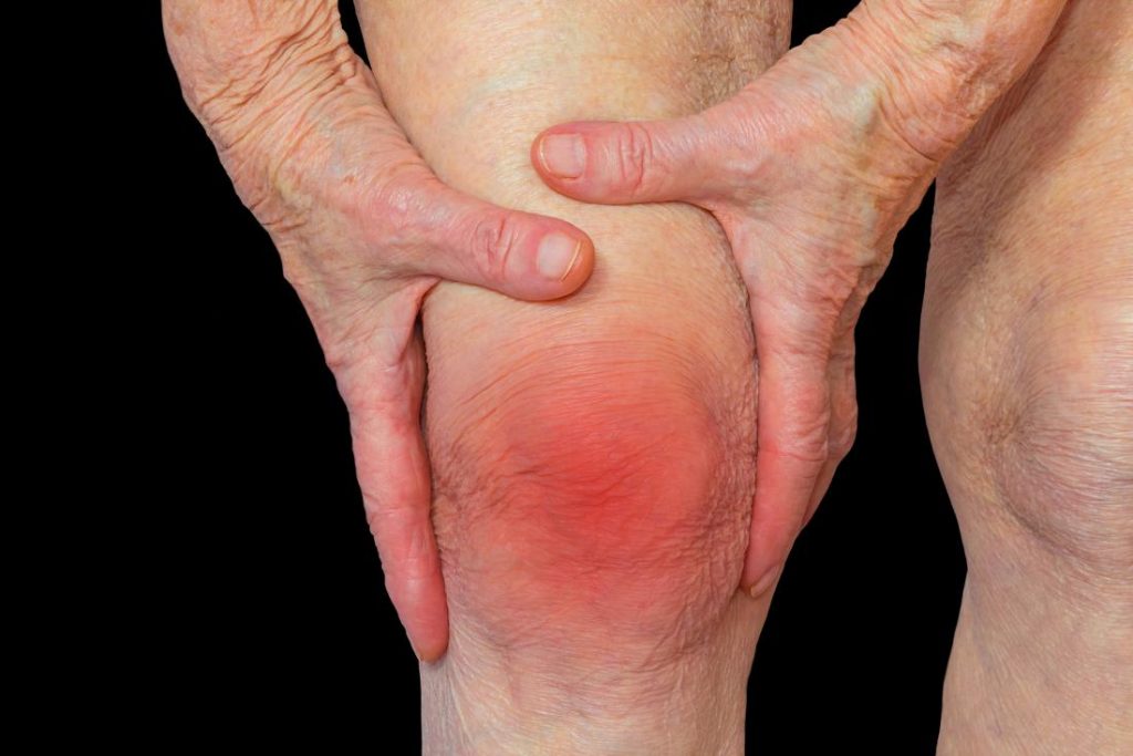 Radang sendi rheumatoid arthritis