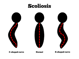 scoliosis adalah penyakit