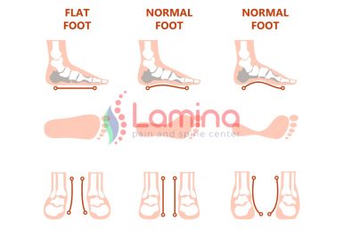 Bahaya telapak kaki datar atau flat foot adalah