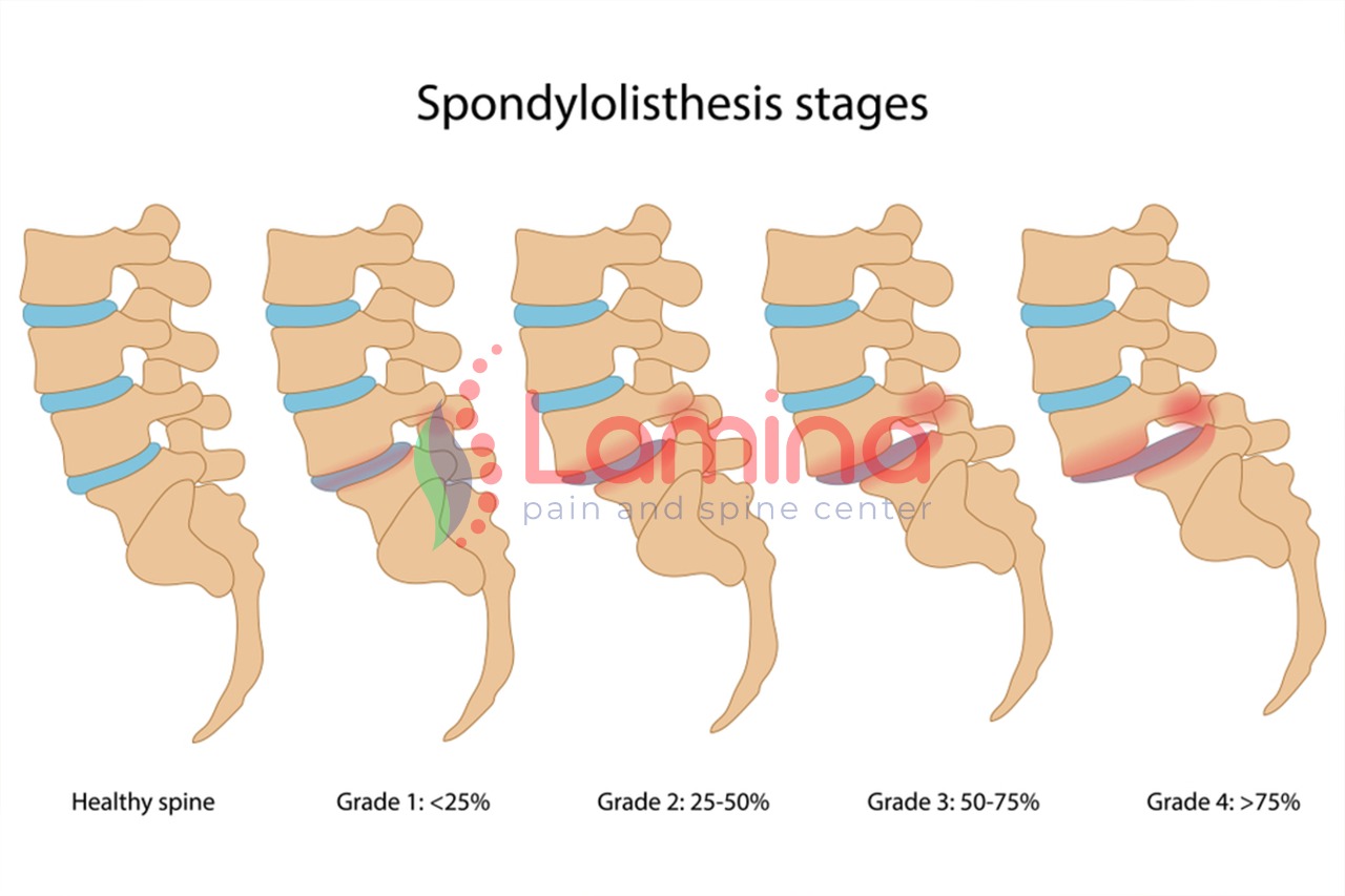 Bergesernya tulang belakang adalah spondilolistesis