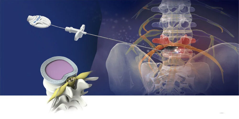 Epidural Steroid Injection (ESI) - rumah sakit khusus bedah lamina